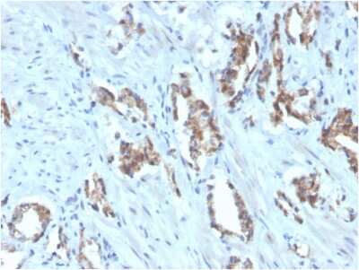 Immunohistochemistry-Paraffin: TIGIT Antibody (TIGIT/3106) [NBP2-79794] - Formalin-fixed, paraffin-embedded human prostate carcinoma stained with Biotin-conjugated TIGIT Mouse Monoclonal Antibody (TIGIT/3106).