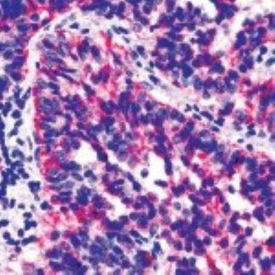 Immunohistochemistry-Paraffin: TIMP-2 Antibody (3A4) [NBP2-26428] - Analysis of TIMP2 formalin-fixed paraffin embedded human pancreatic tumor using NBP2-26428.