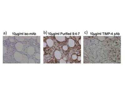 Immunohistochemistry-Paraffin: TIMP-4 Antibody (9.4-7) [NBP2-21658] - Mouse Anti-TIMP-4 Antibody. Tissue: human breast carcinoma. Fixation: formalin fixed paraffin embedded.  Antigen retrieval: not required. a) isotype specific IgG2bk monoclonal; b) TIMP-4 antibody ; and c) TIMP-4 each at 10 ug/mL. Secondary antibody: Peroxidase mouse secondary antibody at 1:10,000 for 45 min at RT. Localization: TIMP-4 is secreted. Staining: TIMP-4 as precipitated brown signal.