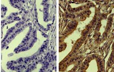 Immunohistochemistry-Paraffin: TIMP-4 Antibody (SB30c) [NBP1-28619] - Human gastric cancer tissue was stained with Mouse Anti-Human TIMP-4-UNLB (right) followed by followed by HRP conjugated Anti-Mouse Ig secondary antibody, DAB, and hematoxylin.