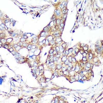 Immunohistochemistry-Paraffin: TIP120B Antibody [NBP2-94561] - Immunohistochemistry of paraffin-embedded Human colon carcinoma using TIP120B Rabbit pAb (NBP2-94561) at dilution of 1:100 (40x lens). Perform microwave antigen retrieval with 10 mM PBS buffer pH 7.2 before commencing with IHC staining protocol.