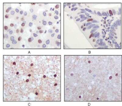 Immunohistochemistry-Paraffin: TIP60 Antibody (3F9G7) [NB110-87055] - Analysis of human liver carcinoma (A), recturn carcinoma (B), normal medulla tissue (C) and normal interbrain tissues (D), showing nuclear localization using Tip60 mouse mAb with DAB staining.