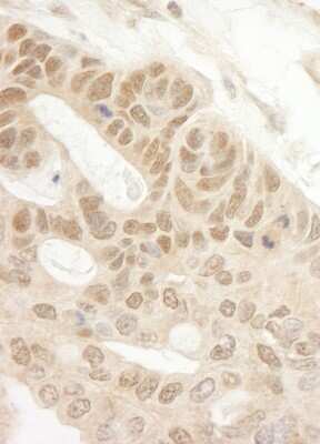 Immunohistochemistry-Paraffin: TIPRL Antibody [NB100-1815] - Sample: FFPE section of human ovarian carcinoma. Antibody: Affinity purified rabbit anti- Tip41 used at a dilution of 1:200 (1ug/ml). Detection: DAB