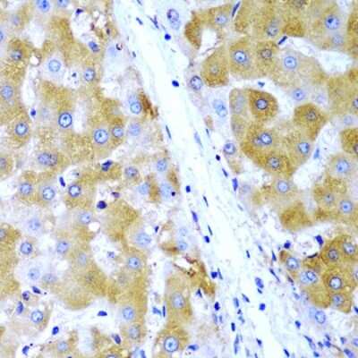 Immunohistochemistry-Paraffin: TIRAP Antibody [NBP3-04543] - Paraffin-embedded human liver cancer using TIRAP antibody at dilution of 1:200 (40x lens).