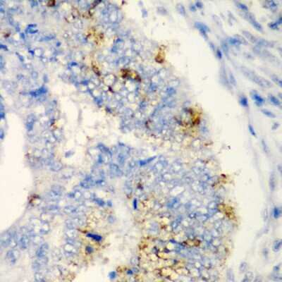 Immunohistochemistry-Paraffin: TIRAP Antibody [NBP3-04543] - Paraffin-embedded human colon carcinoma using TIRAP antibody at dilution of 1:200 (40x lens).