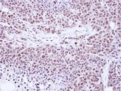 Immunohistochemistry-Paraffin: TKTL1 Antibody [NBP1-31674] - SAS xenograft , using Transketolase-like protein 1 antibody at 1:100 dilution.Antigen Retrieval: Trilogy™ (EDTA based, pH 8.0) buffer, 15min.