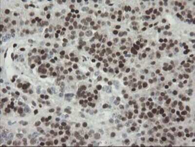 Immunohistochemistry: TLE1 Antibody (OTI1H2) [NBP2-46134] - Analysis of Carcinoma of Human pancreas tissue.