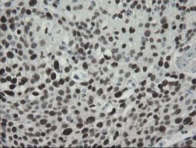 Immunohistochemistry: TLE1 Antibody (OTI1H2) [NBP2-46134] - Analysis of Carcinoma of Human bladder tissue.