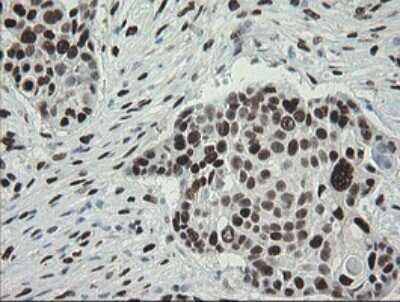 Immunohistochemistry: TLE1 Antibody (OTI1H2) [NBP2-46134] - Analysis of Carcinoma of Human lung tissue.