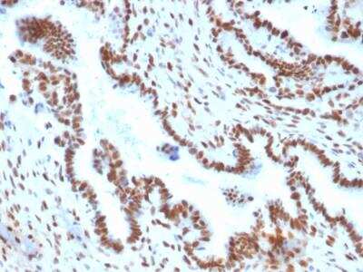 Immunohistochemistry-Paraffin: TLE1 Antibody (TLE1/2051) - Azide and BSA Free [NBP2-79913] - Formalin-fixed, paraffin-embedded human Endometrial Carcinoma stained with TLE1 Mouse Monoclonal Antibody (TLE1/2051).