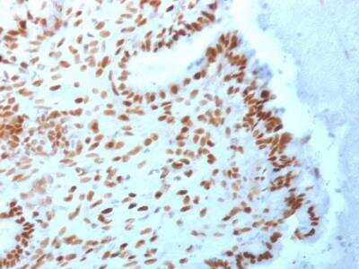 Immunohistochemistry-Paraffin: TLE1 Antibody (TLE1/2062) - Azide and BSA Free [NBP2-79914] - Formalin-fixed, paraffin-embedded human Endometrial Carcinoma stained with TLE1 Mouse Monoclonal Antibody (TLE1/2062).