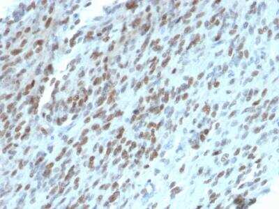 Immunohistochemistry-Paraffin: TLE1 Antibody (TLE1/2062) - Azide and BSA Free [NBP2-79914] - Formalin-fixed, paraffin-embedded human GIST stained with TLE1 Mouse Monoclonal Antibody (TLE1/2062).