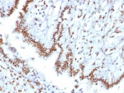 Immunohistochemistry-Paraffin: TLE1 Antibody (TLE1/2085) [NBP3-07727] - Formalin-fixed, paraffin-embedded human Endometrial Carcinoma stained with TLE1 Mouse Monoclonal Antibody (TLE1/2085).