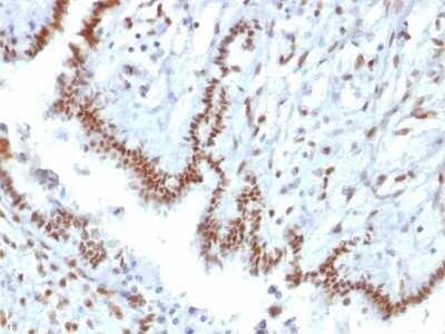 Immunohistochemistry-Paraffin: TLE1 Antibody (TLE1/2085) [NBP3-08727] - Formalin-fixed, paraffin-embedded human Endometrial Carcinoma stained with TLE1 Mouse Monoclonal Antibody (TLE1/2085).