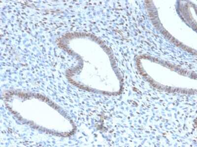 Immunohistochemistry-Paraffin: TLE1 Antibody (TLE1/2946R) - Azide and BSA Free [NBP3-08731] - Formalin-fixed, paraffin-embedded human Endometrial Carcinoma stained with TLE1 Rabbit Recombinant Monoclonal Antibody (TLE1/2946R).