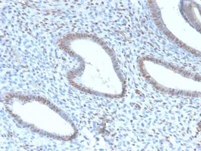 Immunohistochemistry-Paraffin: TLE1 Antibody (TLE1/2946R) [NBP3-07728] - Formalin-fixed, paraffin-embedded human Endometrial Carcinoma stained with TLE1 Rabbit Recombinant Monoclonal Antibody (TLE1/2946R).