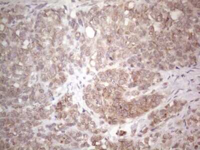 Immunohistochemistry: TLK2 Antibody (OTI2D10) - Azide and BSA Free [NBP2-74532] - Analysis of Adenocarcinoma of Human endometrium tissue. (Heat-induced epitope retrieval by 1mM EDTA in 10mM Tris buffer (pH8.5) at 120C for 3 min)
