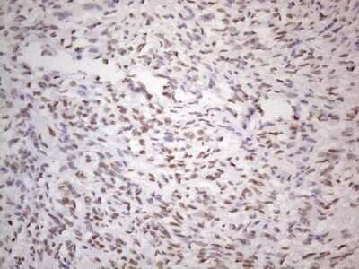 Immunohistochemistry: TLK2 Antibody (OTI2D10) - Azide and BSA Free [NBP2-74532] - Analysis of Adenocarcinoma of Human ovary tissue. (Heat-induced epitope retrieval by 1mM EDTA in 10mM Tris buffer (pH8.5) at 120C for 3 min)