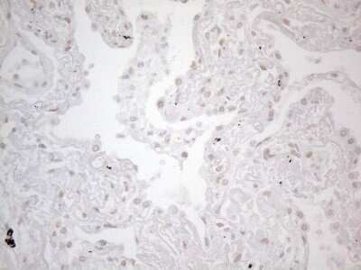Immunohistochemistry: TLK2 Antibody (OTI2D10) - Azide and BSA Free [NBP2-74532] - Analysis of Carcinoma of Human lung tissue.(Heat-induced epitope retrieval by 1mM EDTA in 10mM Tris buffer (pH8.5) at 120C for 3 min)(1:150)