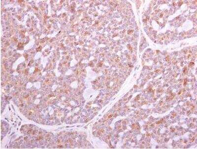 Immunohistochemistry-Paraffin: TLR2 Antibody [NBP2-20652] - Paraffin-embedded human breast carcinoma. TLR2 antibody [N1N2], N-term diluted at 1:500.