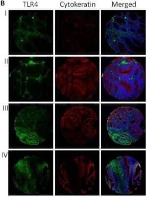 Immunohistochemistry: TLR4 Antibody (76B357.1) - Azide Free [NBP2-27149] - Immunofluorescent staining of TMAs. Representative tissue cores from normal (I), adenomatous polyps (II), and CRC (III and IV) are shown. Image collected and cropped by CiteAb from the following publication (//www.jeccr.com/content/33/1/45), licensed under a CC-BY license. Image using the standard format of this product.