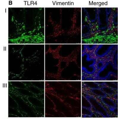 Immunohistochemistry: TLR4 Antibody (76B357.1) - Azide Free [NBP2-27149] - Pericryptal Myofibroblasts are Responsible for Increased TLR4 Expression in a Subset of CRCs. Double-stained immunofluorescence for TLR4 (green) and vimentin (red) in normal (I), adenoma (II), and colon adenocarcinoma (III) (10x). In the stromal compartment of CRCs, immunofluorescent staining for TLR4 localized to the pericryptal myofibroblasts in a subset of samples. Image collected and cropped by CiteAb from the following publication (//www.jeccr.com/content/33/1/45), licensed under a CC-BY license. Image using the standard format of this product.