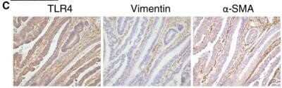 Immunohistochemistry: TLR4 Antibody (76B357.1) - Azide Free [NBP2-27149] - Pericryptal Myofibroblasts are Responsible for Increased TLR4 Expression in a Subset of CRCs. IHC staining of colon adenocarcinoma for TLR4, vimentin, and alpha-SMA (40x). Staining co-localizes to the pericryptal space, confirming the signal arises from pericryptal myofibroblasts. Image collected and cropped by CiteAb from the following publication (//www.jeccr.com/content/33/1/45), licensed under a CC-BY license. Image using the standard format of this product.