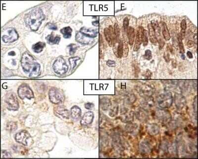 Immunohistochemistry: TLR7 Antibody - Azide Free [NBP2-24905] - Expression of the TLRs 5 and 7 were evaluated in the PDAC tissue by their staining intensity using TLR5 antibody (NBP2-24787) and TLR7 antibody (NBP2-24906). Note negative staining in E and G; positive staining in F and H. For TLR7 immunopositivity was detectable in the cytoplasm with no notable membranous or nuclear positivity. TLR5 showed distinctive nuclear positivity, and detectable positivity in the cytoplasm in some samples. Image collected and cropped by CiteAb from the following publication (//doi.org/10.1371/journal.pone.0219245) licensed under a CC-BY license. Image using the standard format of this product.