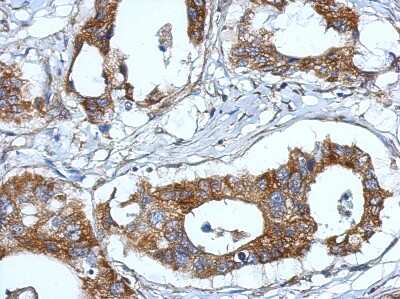 Immunohistochemistry-Paraffin: TM14 Antibody [NBP2-20659] - Immunohistochemical analysis of paraffin-embedded Gastric ca, using antibody at 1:500 dilution.