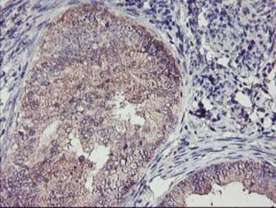 Immunohistochemistry: TMEFF2/Tomoregulin-2 Antibody (OTI1F9) - Azide and BSA Free [NBP2-74537] - Staining of paraffin-embedded Adenocarcinoma of Human endometrium tissue using anti-TMEFF2 mouse monoclonal antibody.