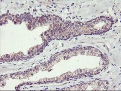 Immunohistochemistry: TMEFF2/Tomoregulin-2 Antibody (OTI1F9) - Azide and BSA Free [NBP2-74537] - Staining of paraffin-embedded Carcinoma of Human prostate tissue using anti-TMEFF2 mouse monoclonal antibody.