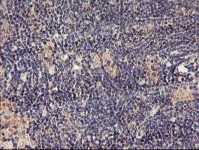 Immunohistochemistry: TMEFF2/Tomoregulin-2 Antibody (OTI1F9) - Azide and BSA Free [NBP2-74537] - Staining of paraffin-embedded Human lymphoma tissue using anti-TMEFF2 mouse monoclonal antibody.