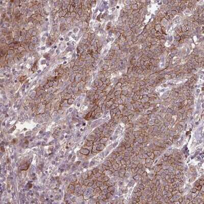 Immunohistochemistry-Paraffin: TMEM88 Antibody [NBP2-13457] - Staining of human lung cancer shows strong membranous positivity.