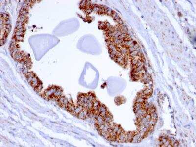 Immunohistochemistry-Paraffin: TMEPAI Antibody (PMEPA1/2696) - Azide and BSA Free [NBP2-79891] - Formalin-fixed, paraffin-embedded human Prostate Carcinoma stained with PMEPA1 Mouse Monoclonal Antibody (PMEPA1/2696).