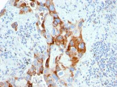 Immunohistochemistry-Paraffin: TMEPAI Antibody (PMEPA1/2696) - Azide and BSA Free [NBP2-79891] - Formalin-fixed, paraffin-embedded human Colon Carcinoma stained with PMEPA1 Mouse Monoclonal Antibody (PMEPA1/2696).