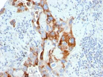 Immunohistochemistry-Paraffin: TMEPAI Antibody (PMEPA1/2696) [NBP2-79756] - Formalin-fixed, paraffin-embedded human Colon Carcinoma stained with TMEPAI Antibody (PMEPA1/2696).