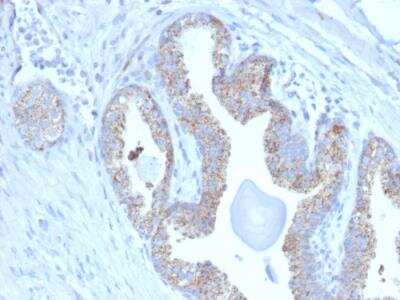 Immunohistochemistry-Paraffin: TMEPAI Antibody (PMEPA1/2697) - Azide and BSA Free [NBP2-79892] - Formalin-fixed, paraffin-embedded human Prostate Carcinoma stained with PMEPA1 Mouse Monoclonal Antibody (PMEPA1/2697).