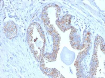 Immunohistochemistry-Paraffin: TMEPAI Antibody (PMEPA1/2697) [NBP2-79757] - Formalin-fixed, paraffin-embedded human Prostate Carcinoma stained with TMEPAI Antibody (PMEPA1/2697).