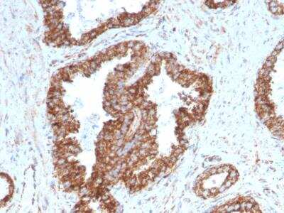 Immunohistochemistry-Paraffin: TMEPAI Antibody (PMEPA1/2698) - Azide and BSA Free [NBP2-79893] - Formalin-fixed, paraffin-embedded human Prostate Carcinoma stained with PMEPA1 Mouse Monoclonal Antibody (PMEPA1/2698).
