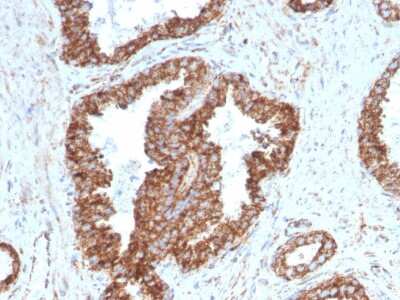 Immunohistochemistry-Paraffin: TMEPAI Antibody (PMEPA1/2698) [NBP2-79758] - Formalin-fixed, paraffin-embedded human Prostate Carcinoma stained with TMEPAI Antibody (PMEPA1/2698).