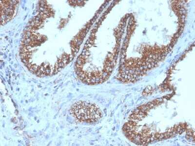 Immunohistochemistry-Paraffin: TMEPAI Antibody (PMEPA1/6421R) - Azide and BSA Free [NBP3-08260] - Formalin-fixed, paraffin-embedded human prostate carcinoma stained with TMEPAI Recombinant Rabbit Monoclonal Antibody (TMEPAI/6421R).