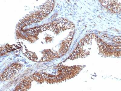 Immunohistochemistry-Paraffin: TMEPAI Antibody (PMEPA1/6421R) [NBP3-07246] - Formalin-fixed, paraffin-embedded human prostate carcinoma stained with TMEPAI Recombinant Rabbit Monoclonal Antibody (TMEPAI/6421R).