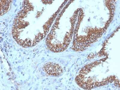 Immunohistochemistry-Paraffin: TMEPAI Antibody (PMEPA1/6421R) [NBP3-07246] - Formalin-fixed, paraffin-embedded human prostate carcinoma stained with TMEPAI Recombinant Rabbit Monoclonal Antibody (TMEPAI/6421R).