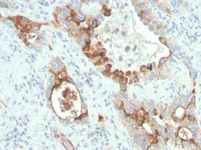 Immunohistochemistry-Paraffin: TMEPAI Antibody (rPMEPA1/6422) - Azide and BSA Free [NBP3-08259] - Formalin-fixed, paraffin-embedded human colon carcinoma stained with TMEPAI Recombinant Mouse Monoclonal (rTMEPAI/6422).