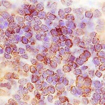 Immunohistochemistry-Paraffin: TMIGD2 Antibody (953730) - Azide Free [MAB83161] - TMIGD2 was detected in immersion fixed paraffin-embedded sections of human thymus using tmigd2 Monoclonal Antibody at 5 ug/ml. Tissue was stained using Goat anti-Mouse IgG Secondary Antibody [HRP Polymer] (brown) and counterstained with hematoxylin (blue). Specific staining was localized to plasma membrane in cancer cells.