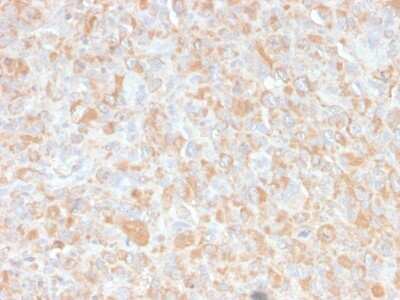 Immunohistochemistry-Paraffin: TNF-alpha Antibody (4C6-H8) - Azide and BSA Free [NBP2-34539] - Formalin-fixed, paraffin-embedded human Histiocytoma stained with TNF-alpha Antibody (4C6-H8).