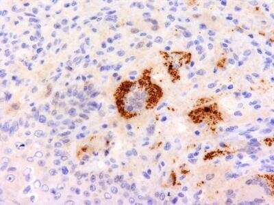 Immunohistochemistry-Paraffin: TNF-alpha Antibody (P/T2) [NBP2-34302] - Formalin-fixed, paraffin-embedded human Erdheim Chester disease (also known as polyostotic sclerosing histiocytosis) stained with TNF alpha Monoclonal Antibody (P/T2).