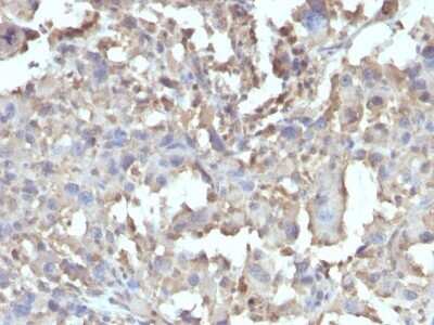 Immunohistochemistry-Paraffin: TNF-alpha Antibody (TNF/1500R) [NBP2-53242] - Formalin-fixed, paraffin-embedded Human Histiocytoma stained with TNF-alpha Recombinant Rabbit Monoclonal Antibody (TNF/1500R).