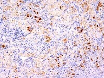 Immunohistochemistry-Paraffin: TNF-alpha Antibody (TNF706 + P/T2) - IHC-Prediluted [NBP2-48471] - Formalin-fixed, paraffin-embedded human Erdheim Chester disease (also known as polyostotic sclerosing histiocytosis) stained with TNF alpha Monoclonal Antibody (TNF706 + P/T2).