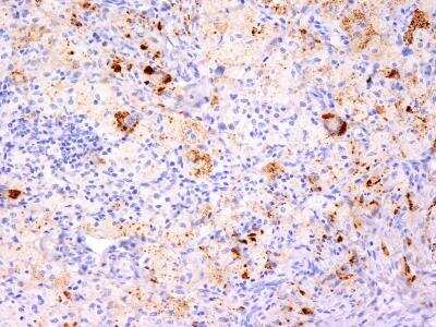 Immunohistochemistry-Paraffin: TNF-alpha Antibody (TNF706 + P/T2) [NBP2-34304] - Formalin-fixed, paraffin-embedded human Erdheim Chester disease (also known as polyostotic sclerosing histiocytosis) stained with TNF alpha Monoclonal Antibody (TNF706 + P/T2).